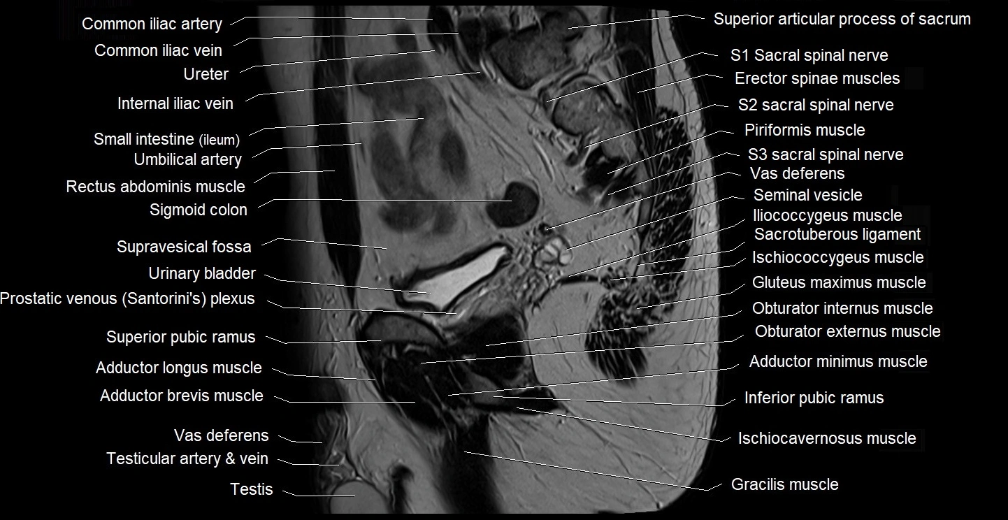 male pelvis sagittal cross sectional anatomy 3T mri image 17.webp